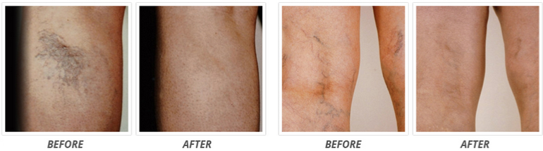 Venorex Before and After Results Comparison