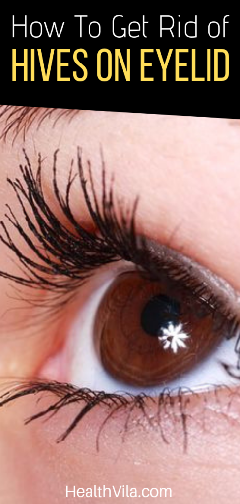 hives-on-eyelids-and-around-under-eyes-causes-treatment-option