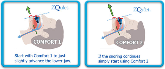 zQuiet Snoring Mouthpiece 1 vs 2